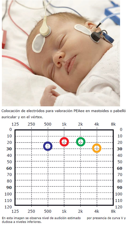 Potenciales Evocados Auditivos De Estado Estable Isabel Olleta